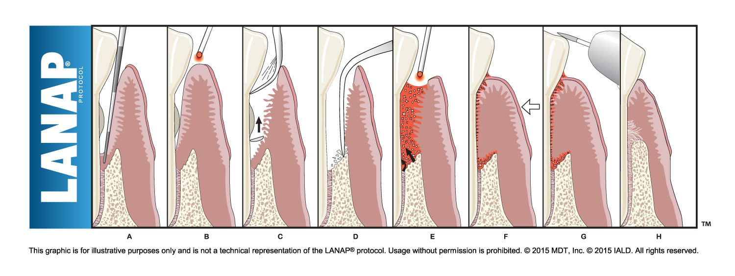 LANAP laser therapy protocol illustrating minimally invasive periodontal disease treatment to restore gum and bone health.